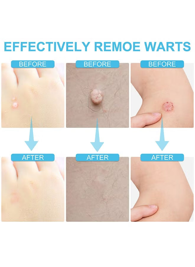 Skin Tag Remover