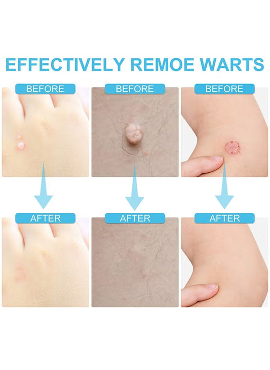Skin Tag Remover