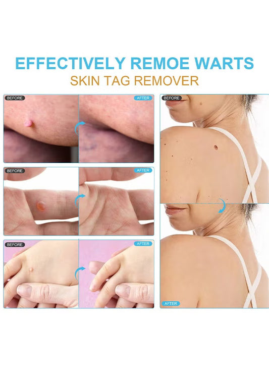 Skin Tag Remover